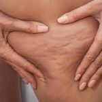 cellulite treatment kl
